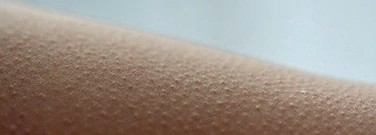 goose-bumps-could-hold-key-stimulating-hair-growth-arch-1761