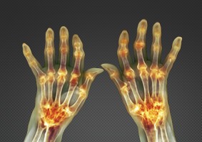 rheumatoid-arthritis-diagnosis-webinar rheumatoid-arthritis-diagnosis-webinar