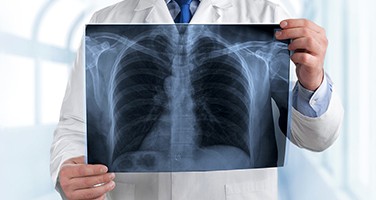 pneumonia-webinar-w-19-0703 pneumonia-webinar-w-19-0703