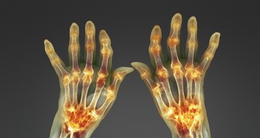 rheumatoid-arthritis-diagnosis-webinar-tmb rheumatoid-arthritis-diagnosis-webinar-tmb